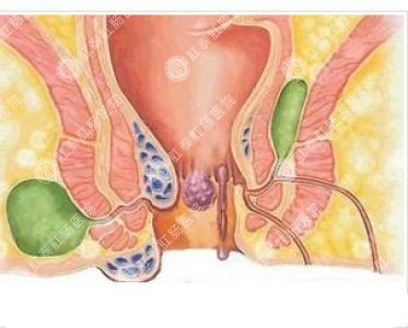 南寧哪個(gè)醫(yī)院可以做肛周膿腫？